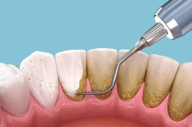 Teeth Cleaning