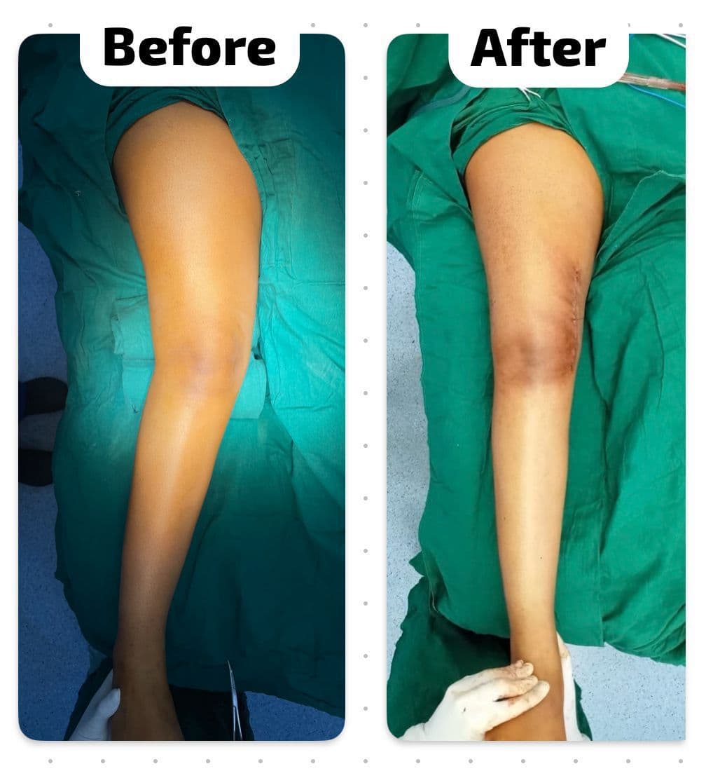 Is Genu Valgum Hereditary? Knock Knees Causes & Treatment