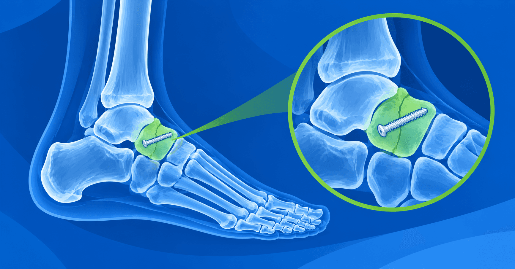 Navicular Fracture Treatment in Yavatmal | Kasare Hospital