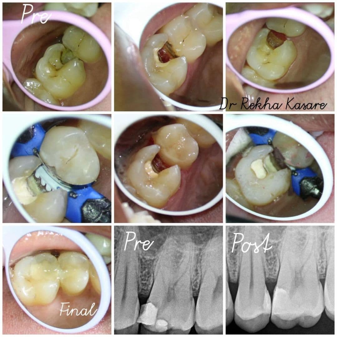 Deep Cavity Case Study: Avoiding Root Canal in Yavatmal